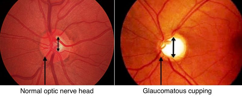 File:Glaucoma-cupping-1024x414.jpg