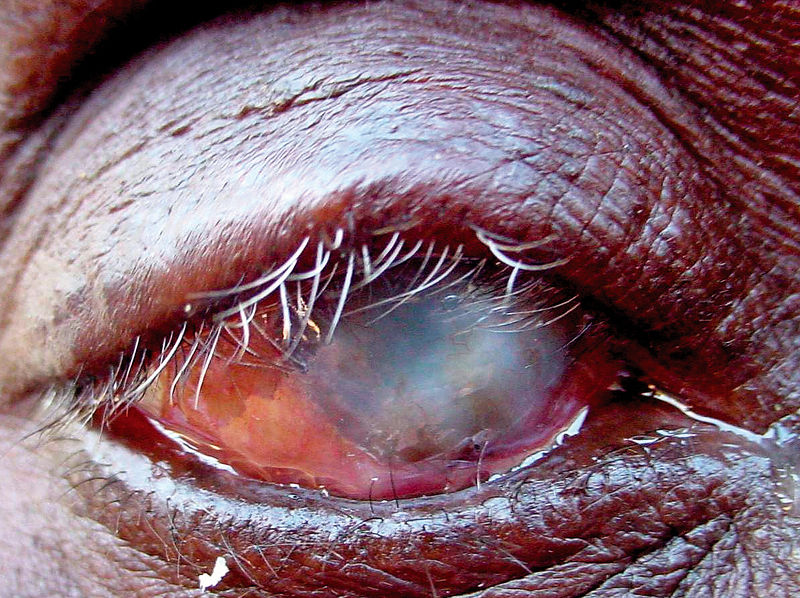File:Corneal scarring trachoma.jpg