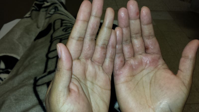 File:Coxsackie 2.jpg