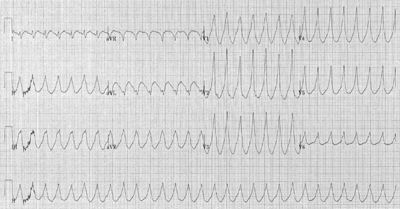 File:Electrocardiogram of Ventricular Tachycardia.png