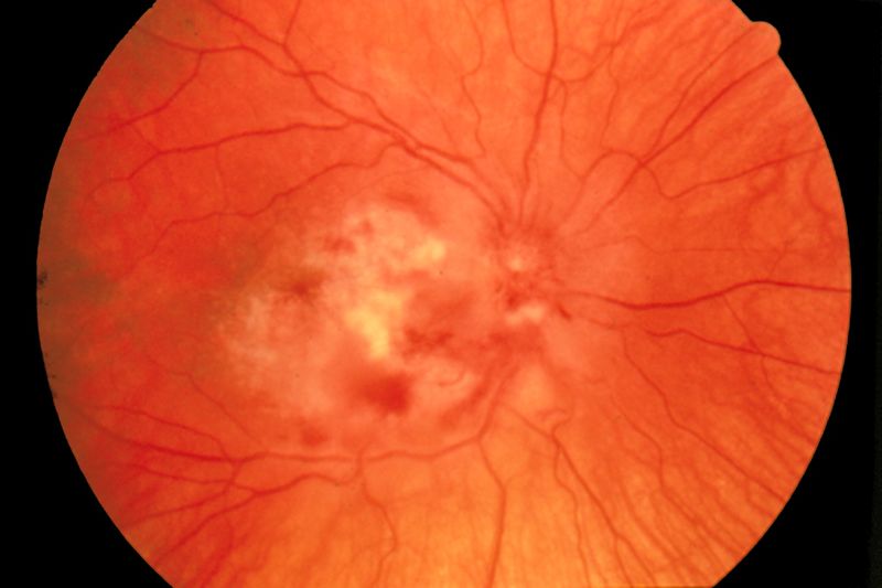 File:Fundus photograph-CMV retinitis EDA07.jpg