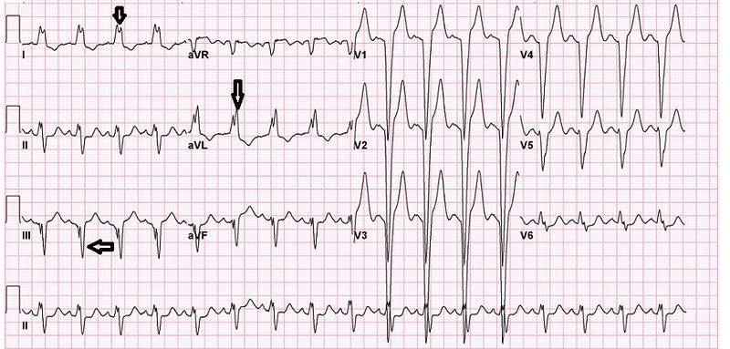File:LBBB.jpg
