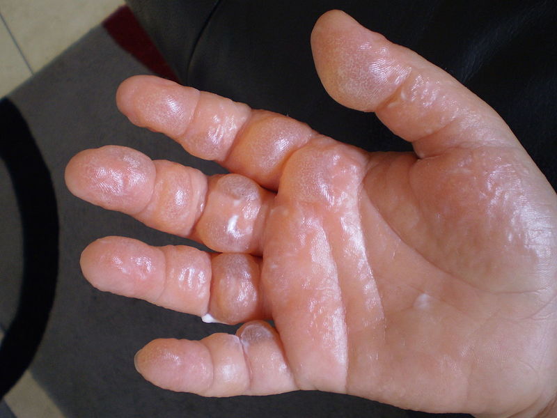 File:Phytophotodermatitis-Severe-Case.jpg