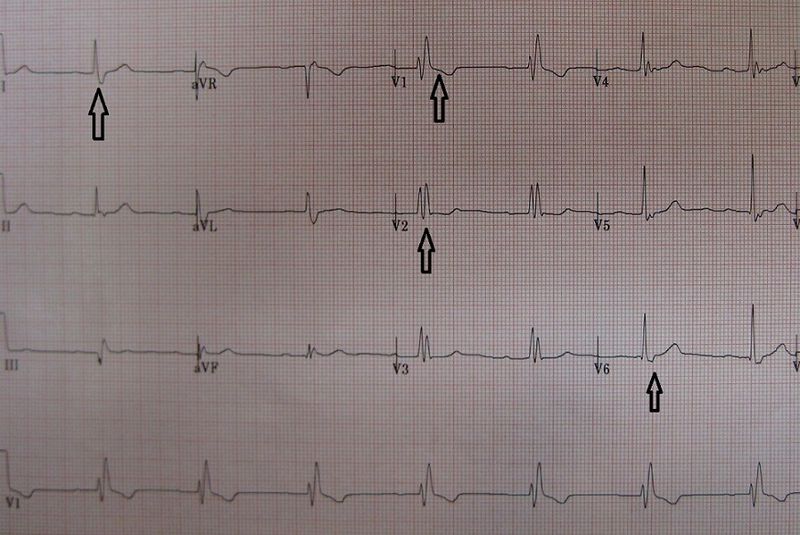 File:RBBB.jpg