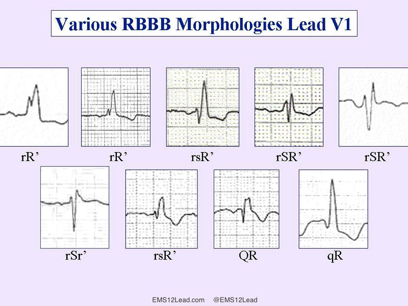 File:Rbbb morphology lead vi wm.jpg