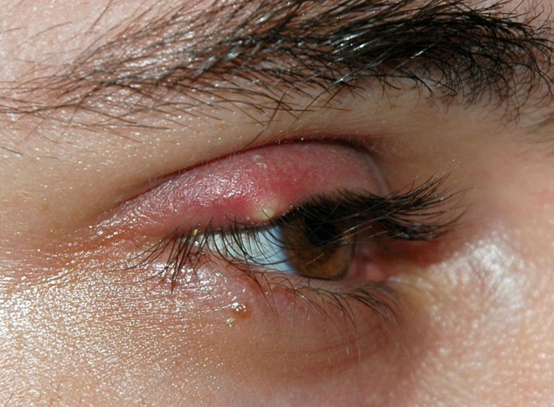 File:Stye02.jpg