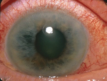 File:Acute Angle Closure-glaucoma.jpg
