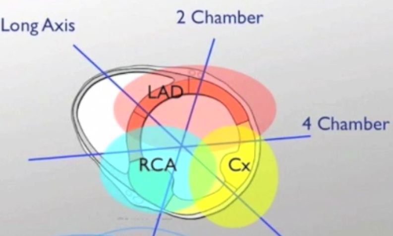 File:Coronary Artery Distribution in Wall Motion Evaluation.png