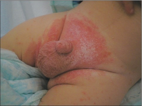 File:Diaper dermatitis.png