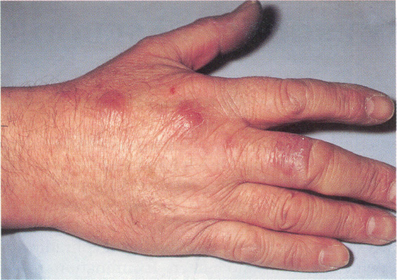 File:Fish Tank Granuloma picture 1.jpg