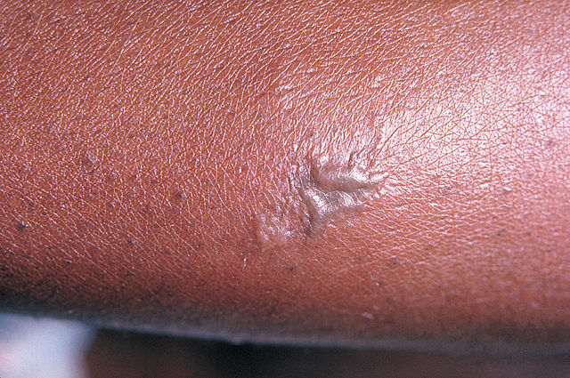 File:Gonococcal lesion on the skin PHIL 2038 lores.jpg
