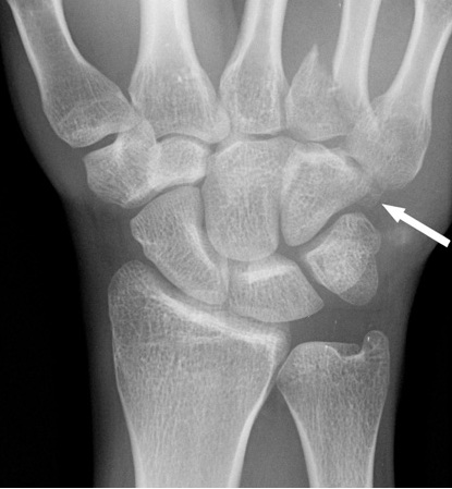 File:Hamate Fracture.jpg