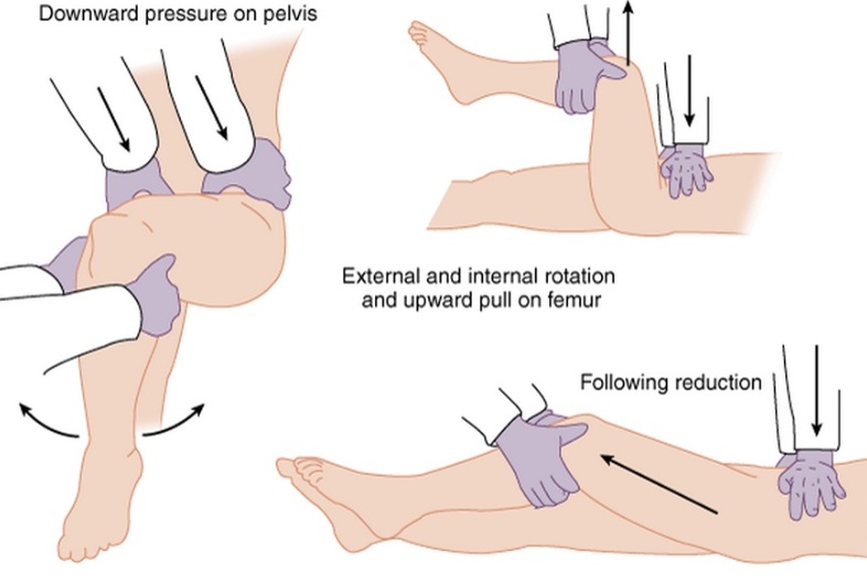 File:Hip Reduction.jpg