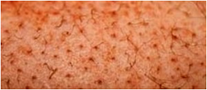 File:Petechiae.png