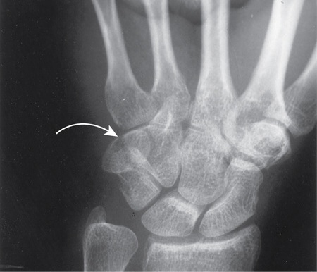 File:Pisiform Fracture.jpg