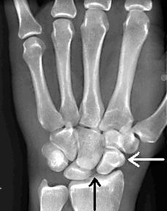 File:Scapholunate Dissociation.jpg