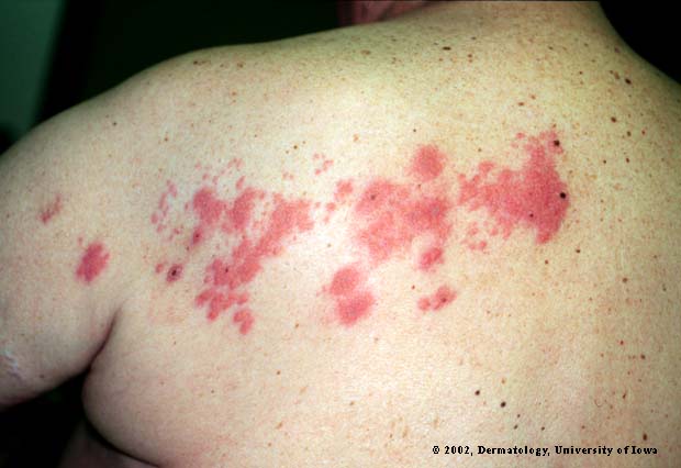 File:Shingles.jpg