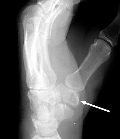 File:Trapezium Fracture.jpg