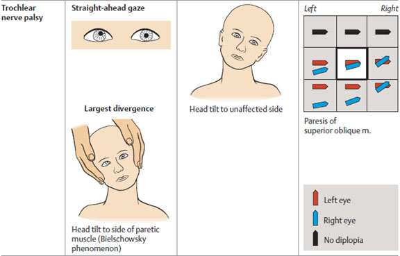 File:Trochlear nerve palsy.jpg