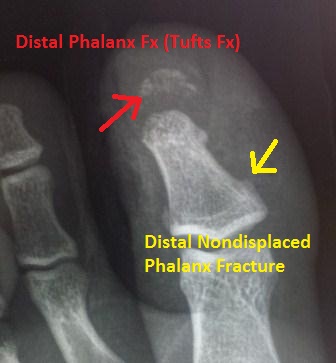 File:Tufts fracture.jpg